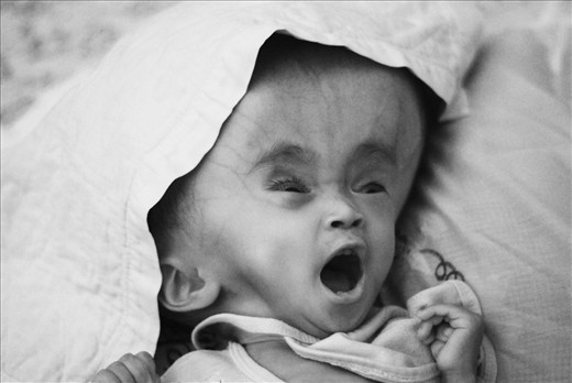 Rizky was suffered from a disease call hydrocephalus. After six times had medical surgery, he died in 2011.