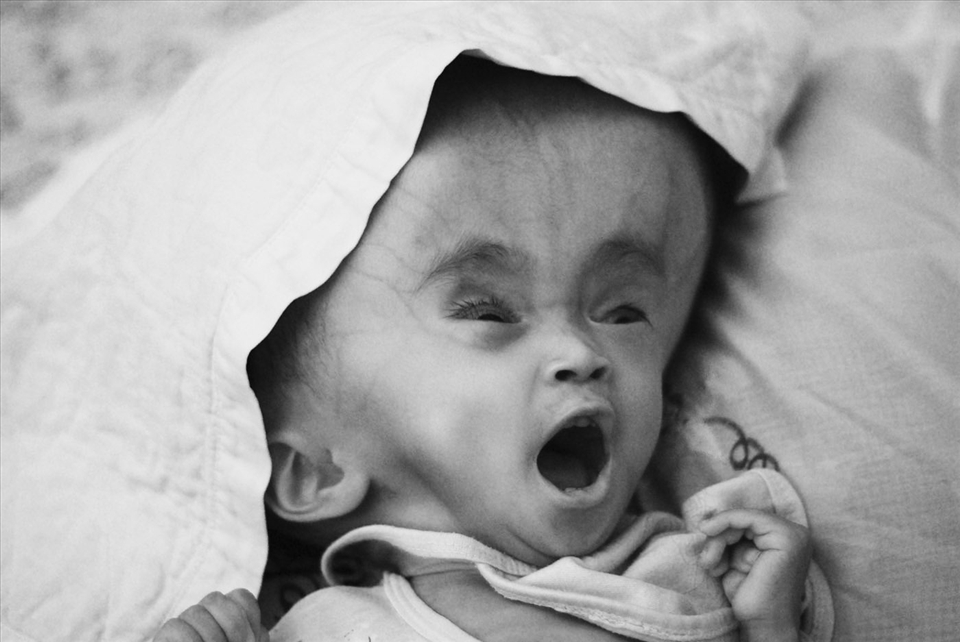 Rizky was suffered from a disease call hydrocephalus. After six times had medical surgery, he died in 2011.