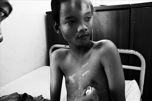 A volunteer give skin medicine to his foster child.