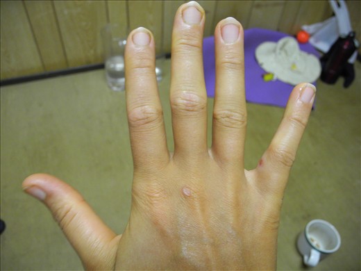 buggered knuckles. that's all.