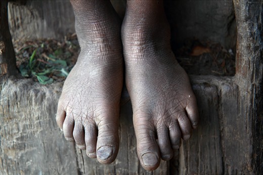 A telling story of a 12-year old’s feet -
The Himalayas is mystical to those who visit and difficult for those who live there. The feet of a 12-year old girl in Jyare village of Mugu district, one of the most isolated districts in Nepal, reveals a childhood spent collecting firewood, working in the field, and grazing cattle in the harsh mountain terrain. 