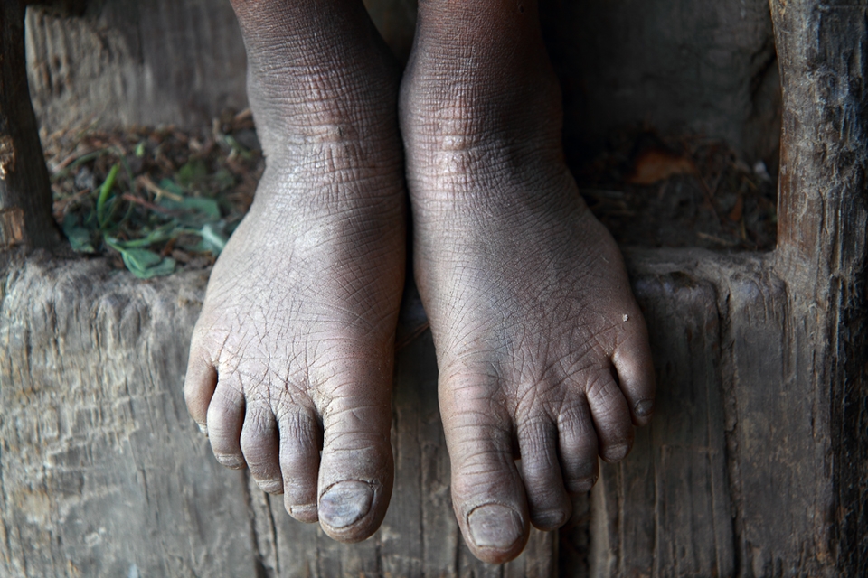 A telling story of a 12-year old’s feet -
The Himalayas is mystical to those who visit and difficult for those who live there. The feet of a 12-year old girl in Jyare village of Mugu district, one of the most isolated districts in Nepal, reveals a childhood spent collecting firewood, working in the field, and grazing cattle in the harsh mountain terrain. 