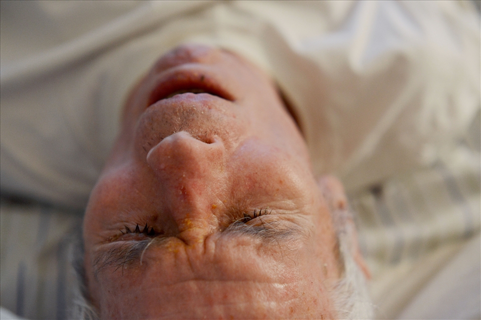 Roger and Eleanor Barnard (not pictured) live in Longview, a residential senior retirement community located in Ithaca, NY. Roger, 86, has suffered from Parkinson's and Alzheimer's since 1992. Roger spends most of his days sleeping and was bedridden for a week or days at a time, thus getting bedsores. 