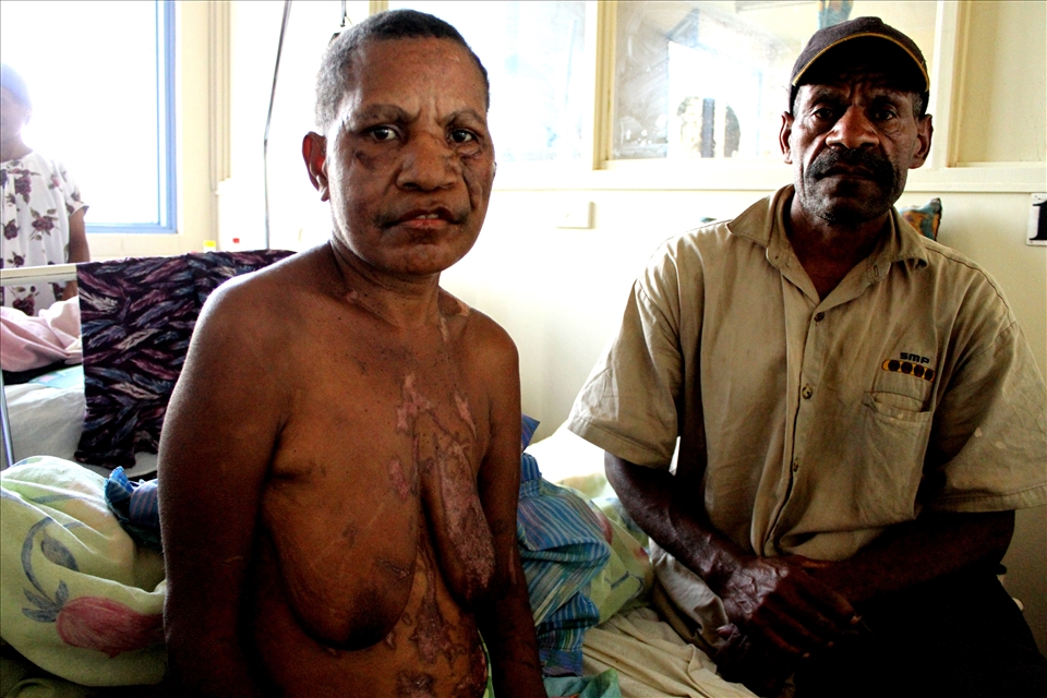 Suare Kande was accused of sorcery, during the 7 day attack she lost 5 fingers and suffered severe burns. Goroka Hospital , Goroka.