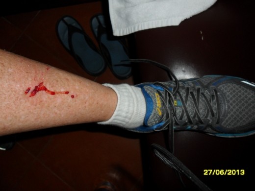 My injuries from not looking where I was going.