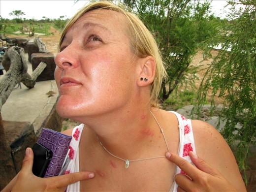 What happens when a blister beetle urinates on you!