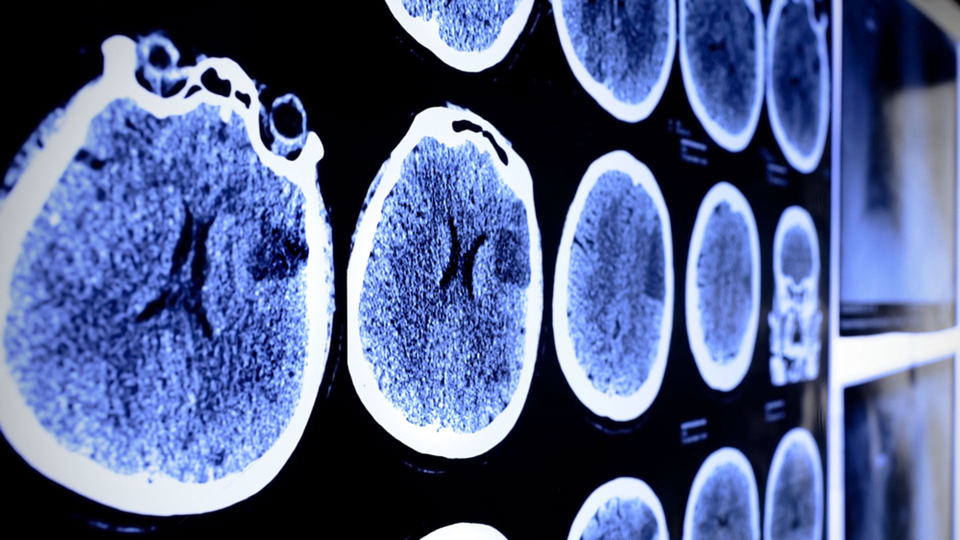 Sentir que tu cerebro se está apagando