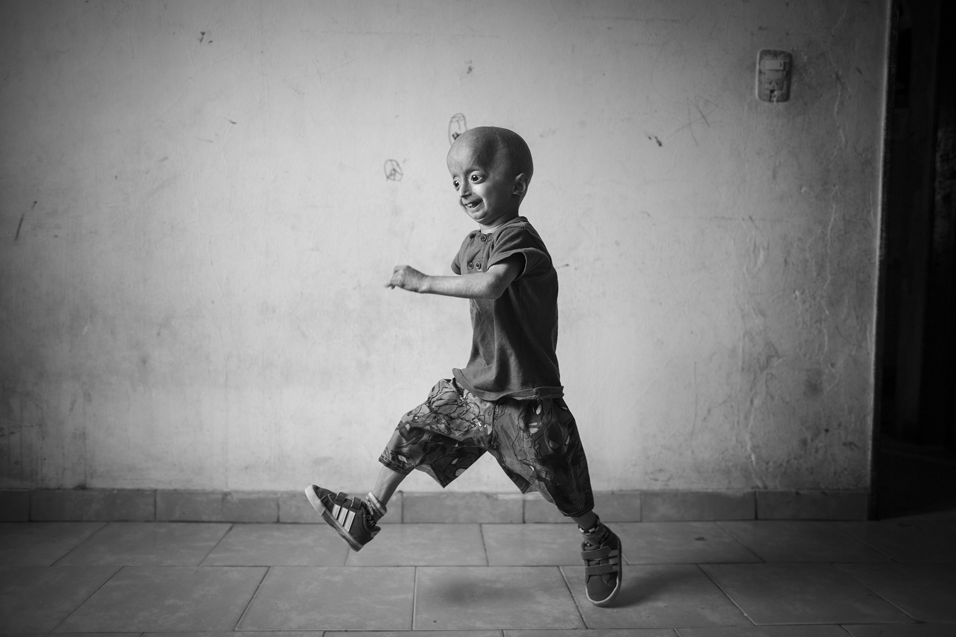 Franco Villavicencio nació con progeria (vejez prematura), una enfermedad que afecta a 300 niños en todo el mundo (Martin Zabala)