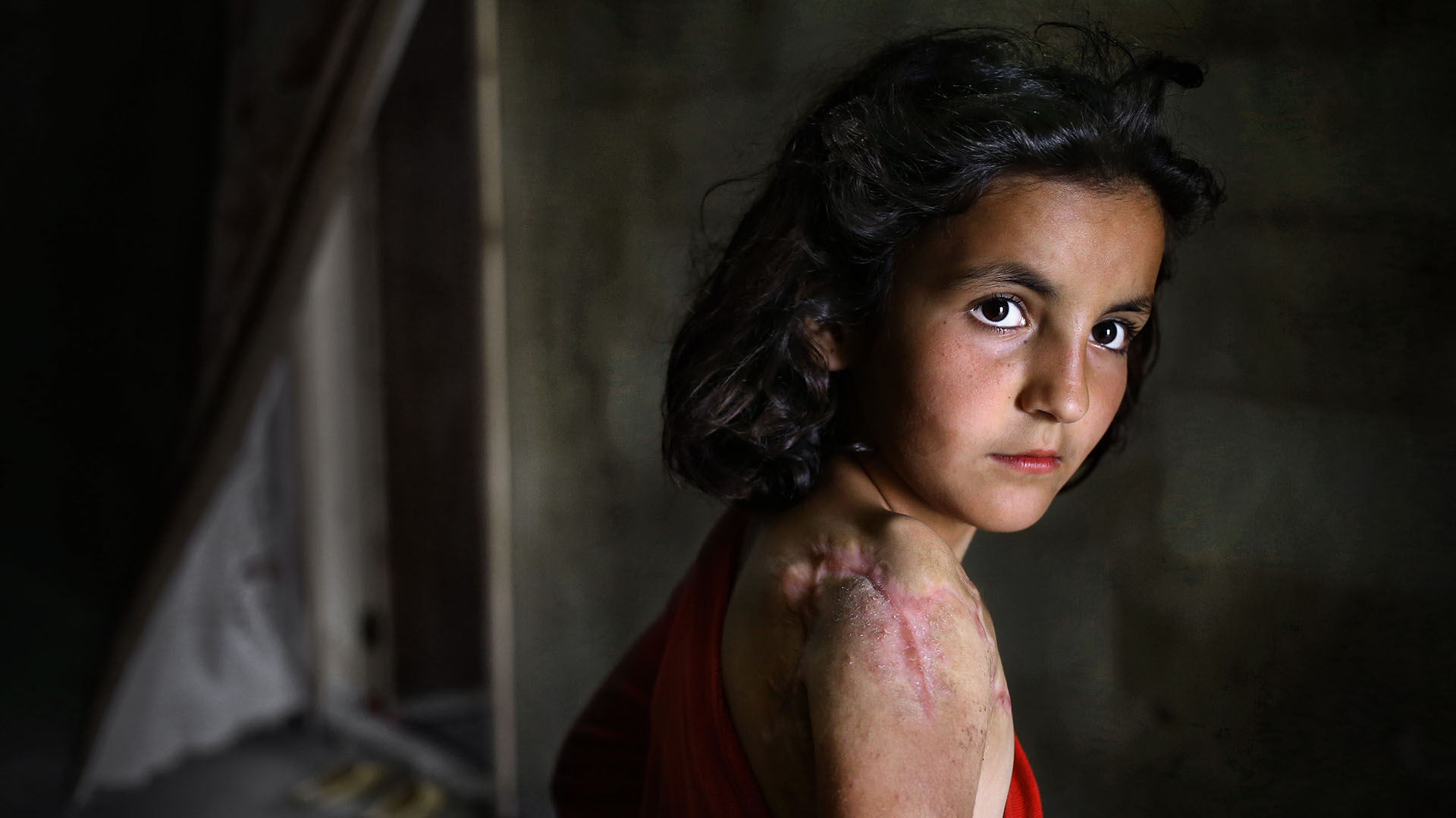 Lujain Hourani, de 11 años, una refugiado siria que perdió parte de su hombro en un ataque aéreo de las fuerzas gubernamentales en la población siria de Zara (AP)