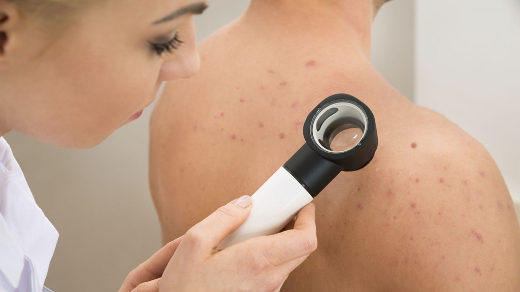 Depósitos en la córnea (conocida como córnea verticillata) y manchas de color rojo oscuro en distintas partes del cuerpo (angioqueratomas) pueden ser indicadores de Fabry (iStock)