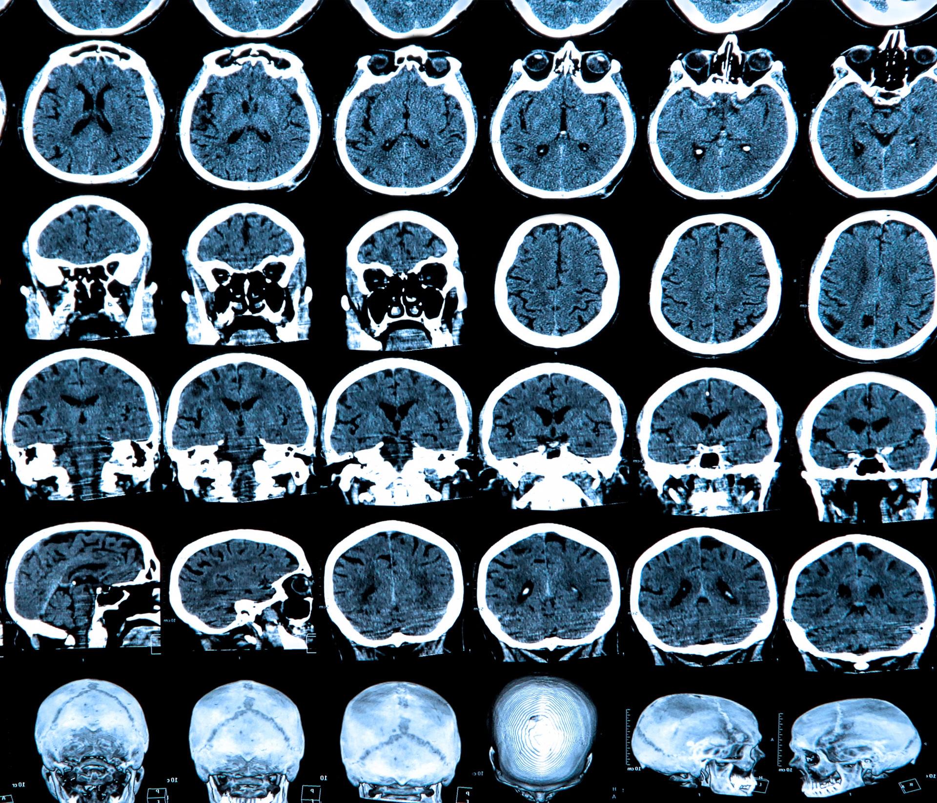 El parkinson afecta la coordinación motriz (iStock)