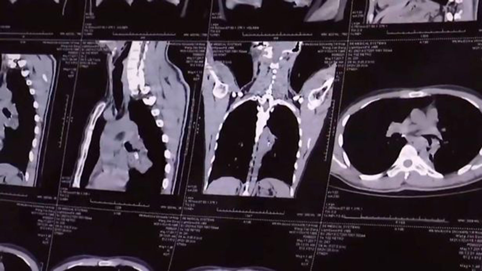 Los médicos le realizaron tomografías cuando llegó al hospital tosiendo sangre y descubrieron un extraño objeto