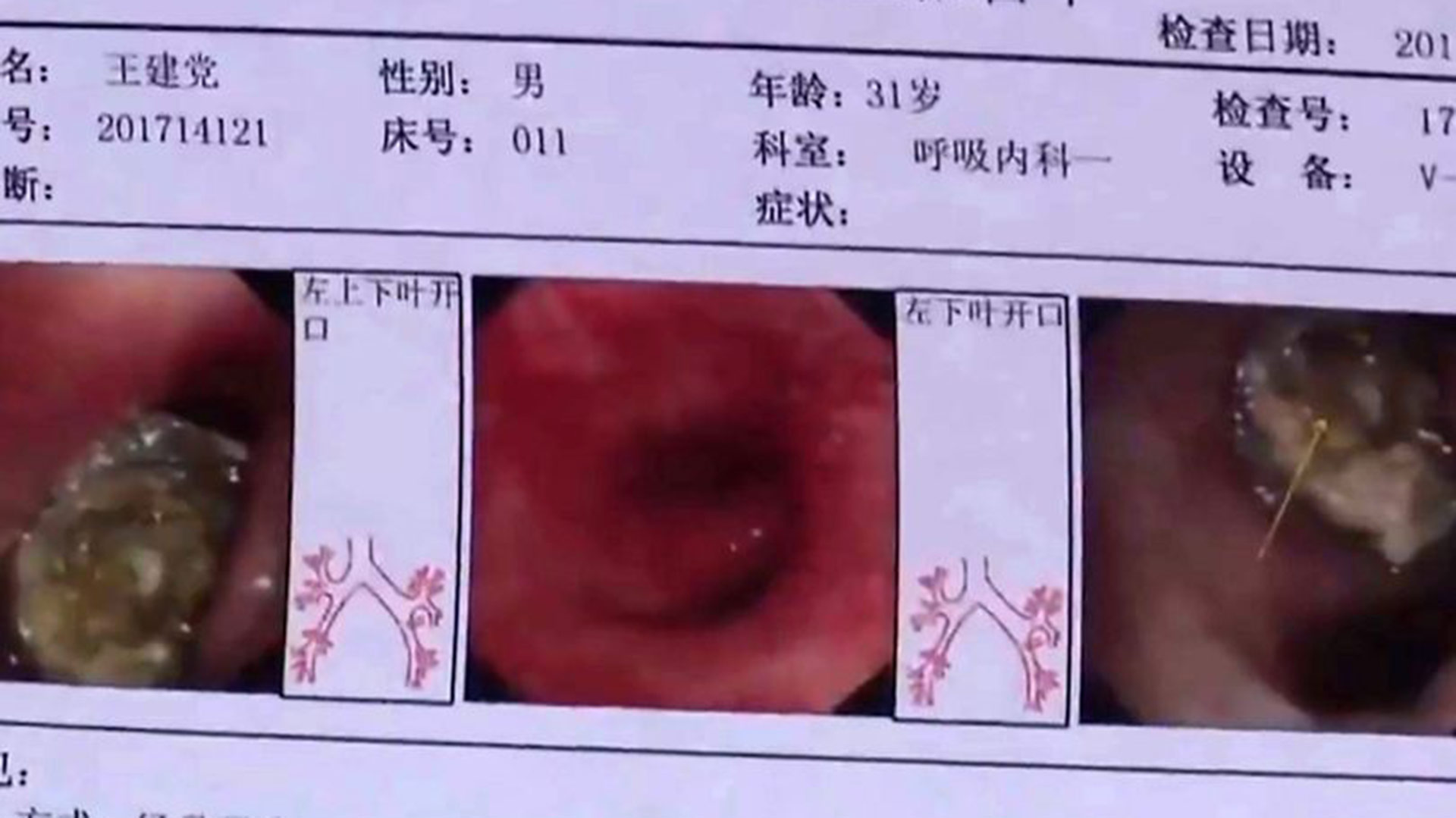 La tapa del bolígrafo estaba parcialmente disuelta en sus pulmones