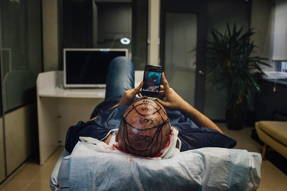 telefono transplante pelo