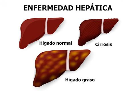 La degeneración del hígado frente a la hepatitis (OMS)