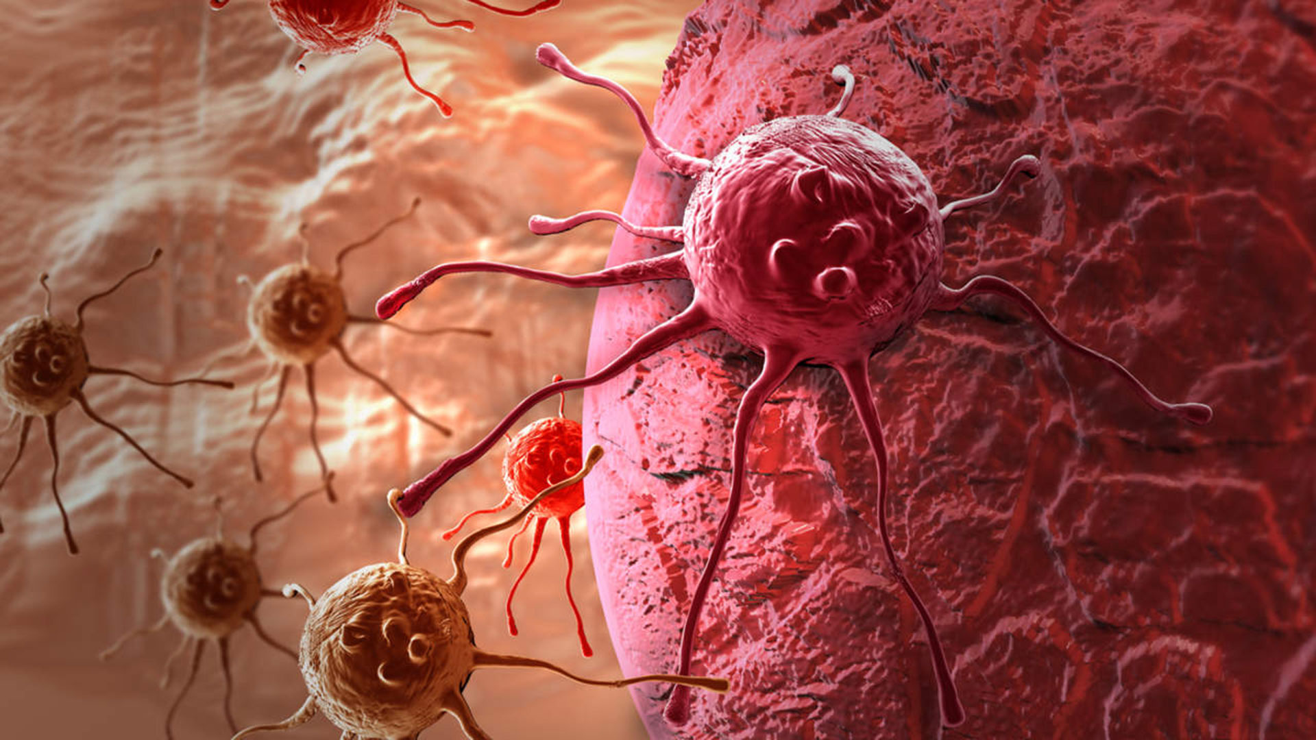 El LACG es un tipo de linfoma no Hodgkin, un cáncer en las células del sistema inmunitario. (iStock)