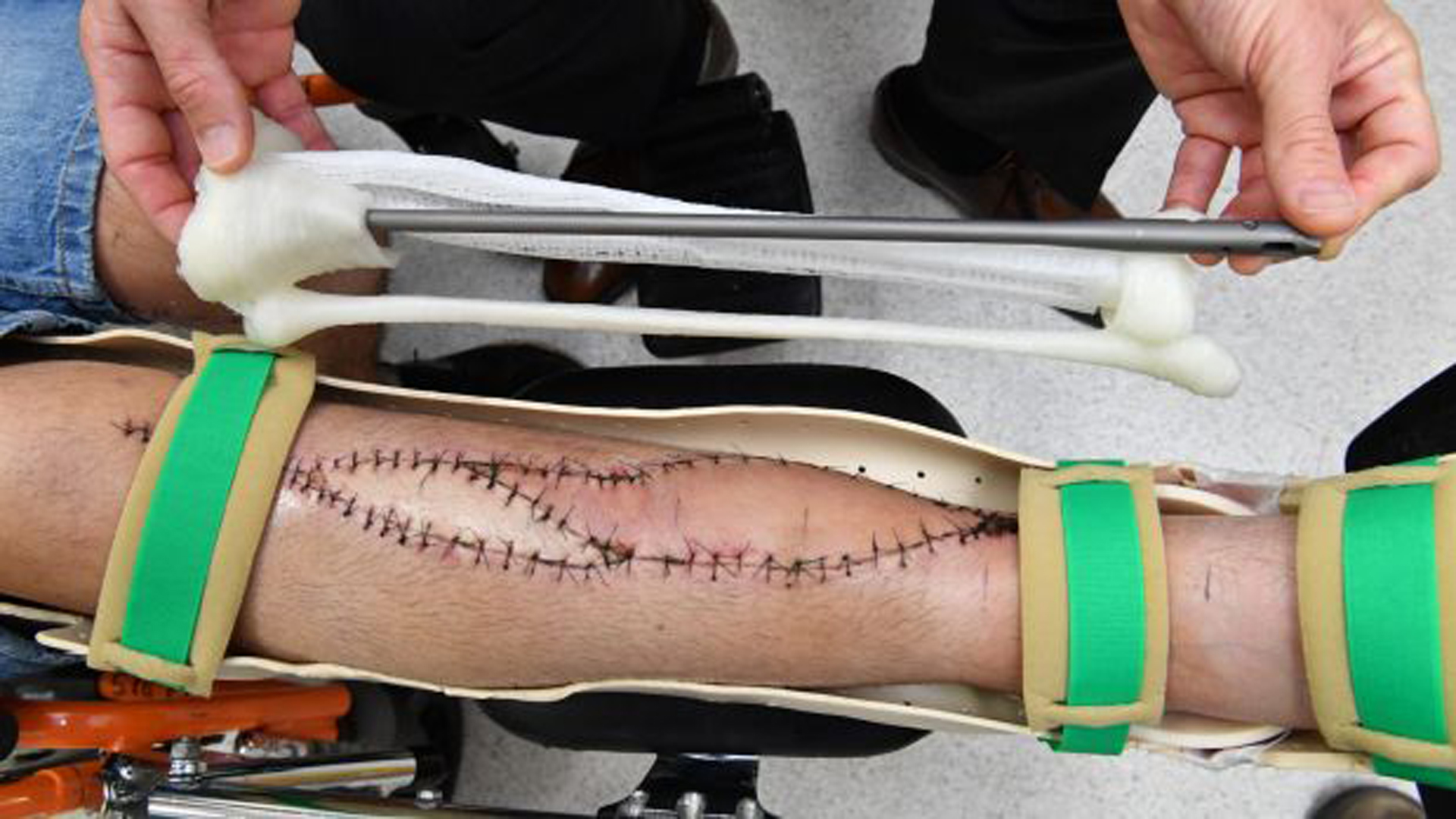 La tibia mide 36 centímetros y fue hecha con una impresora 3D