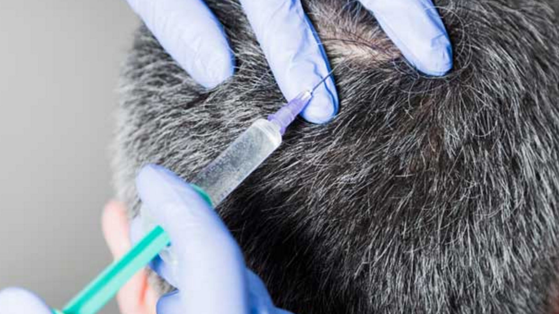 La mesoterapia capilar es la nueva tendencia para recuperar el cabello