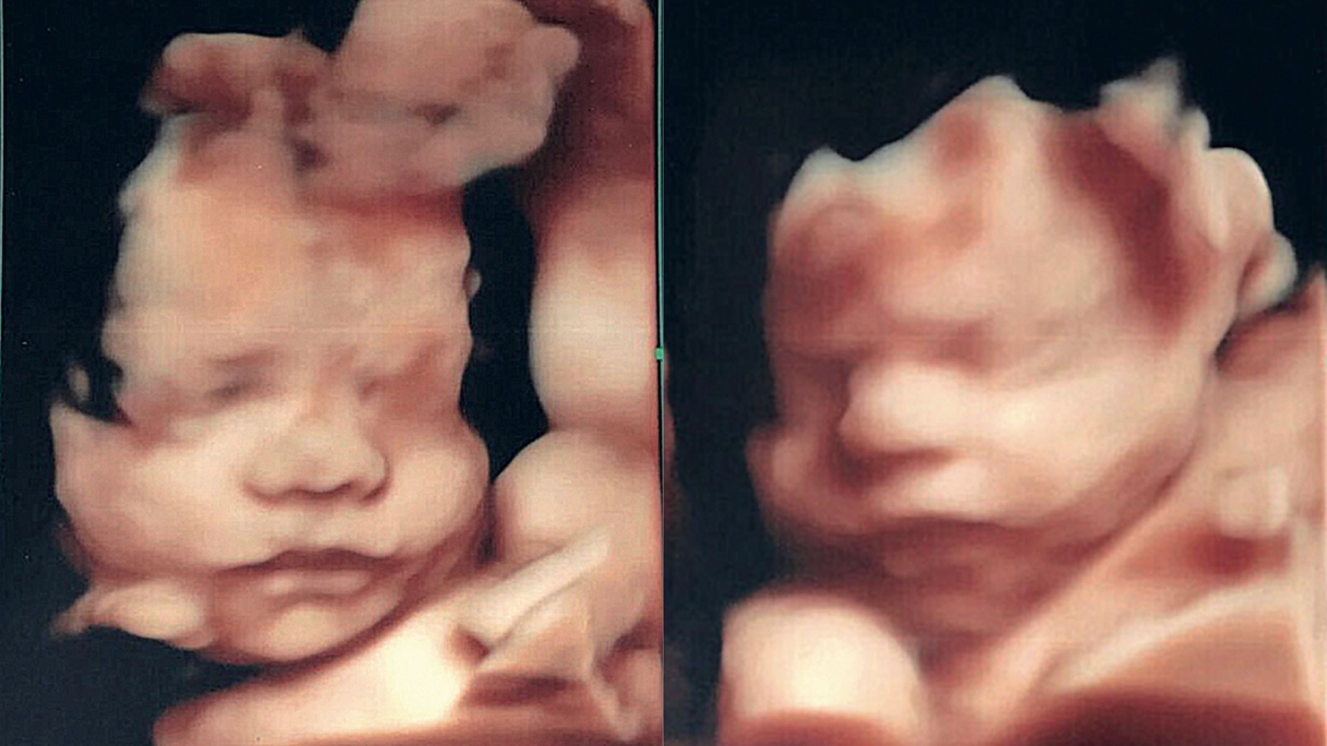 El rostro de Dionisio en su última ecografía 4D. (Foto álbum personal de Flavio Mendoza)