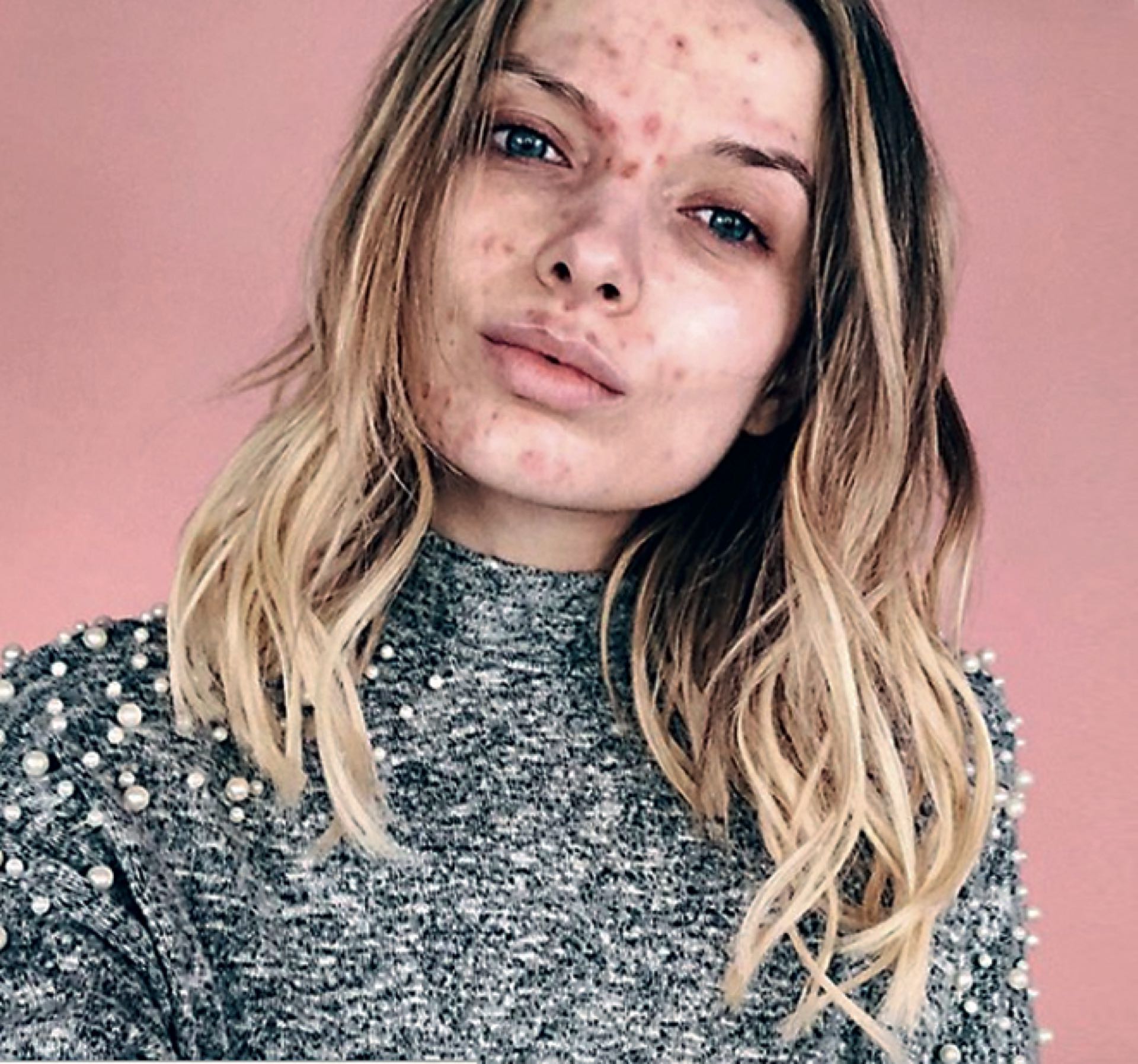 Muestra su acné para animar a quienes padecen este malestar a sentirse bien a pesar de que su piel no se vea radiante, pero también enseña a cuidarla y a maquillar las imperfecciones.