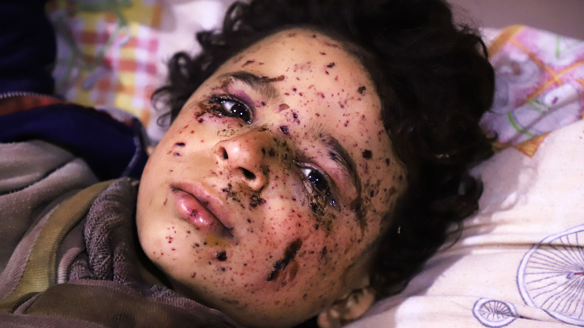 Omar, de 10 años, fue herido en uno de los bombardeos del régimen sirio en Guta. La mayoría de su familia murió en el ataque(AFP)
