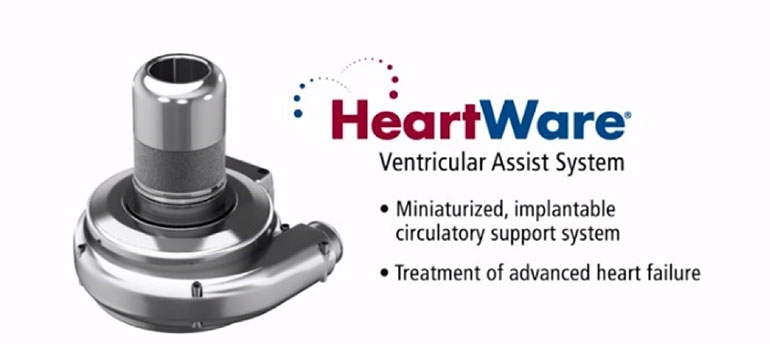 Dispositivo de asistencia ventricular (VAD) Heartware (Foto: Investigación The Implant Files)