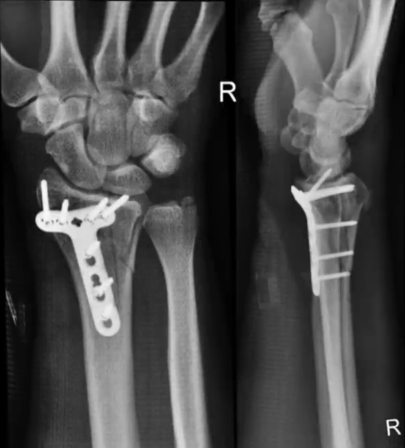 “Me instalaron una placa de titanio y siete tornillos” en la muñeca derecha, fracturada por el impacto de la caída, escribe Gurksy en su video de Youtube