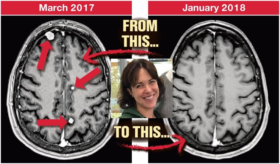 Sus tumores cerebrales desaparecieron (Foto: Especial The Sun)