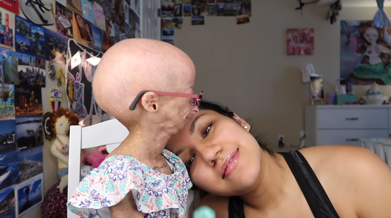 Adalia Rose, la pequeña youtuber con envejecimiento prematuro que conquistó  a millones de seguidores - Infobae, image size:1279x713