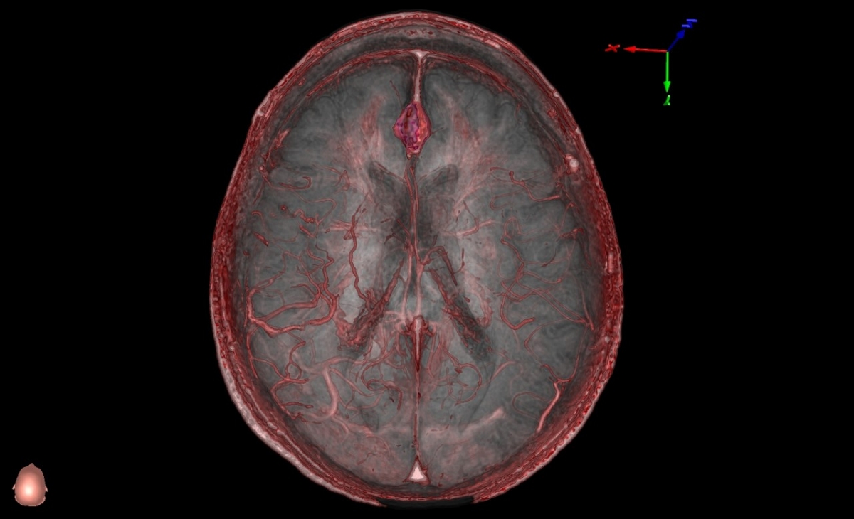 Al alimentar el programa de RV con TC y RNM reales, los médicos se preparan sobre el paciente concreto, no a partir de imágenes generales. (Universidad de Stanford)