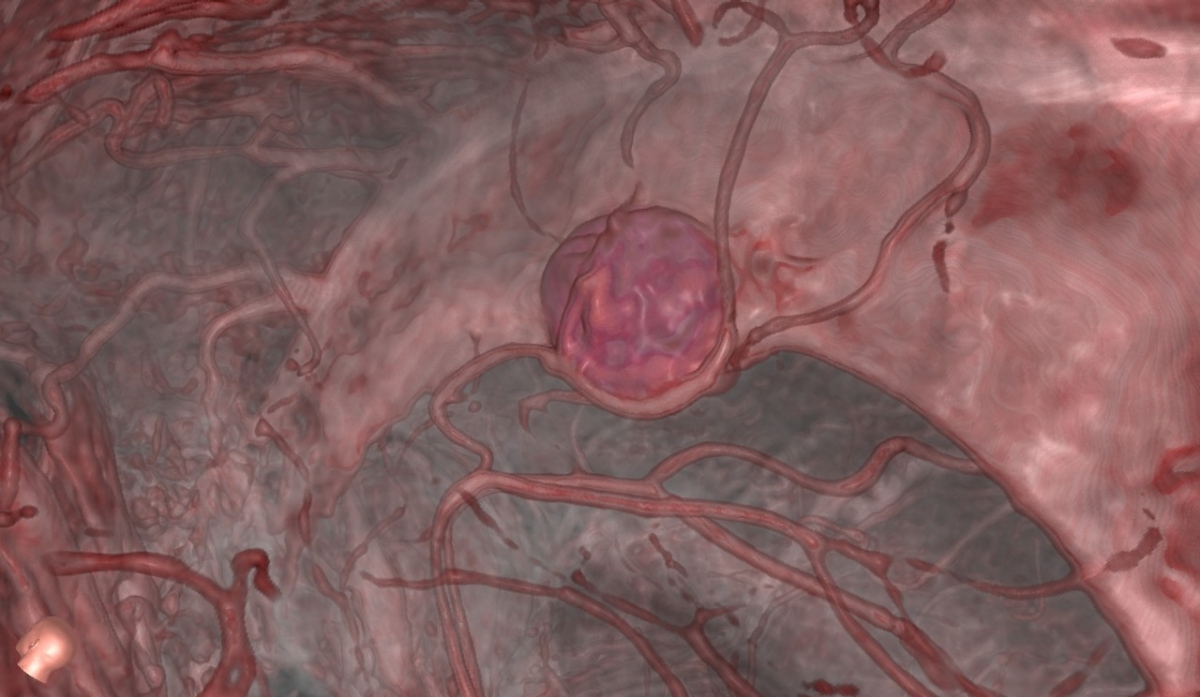 También los pacientes que esperan una cirugía del cerebro pueden ver lo que sucederá en RV, lo cual ayuda a pasar momentos muy angustiantes. (Universidad de Stanford)