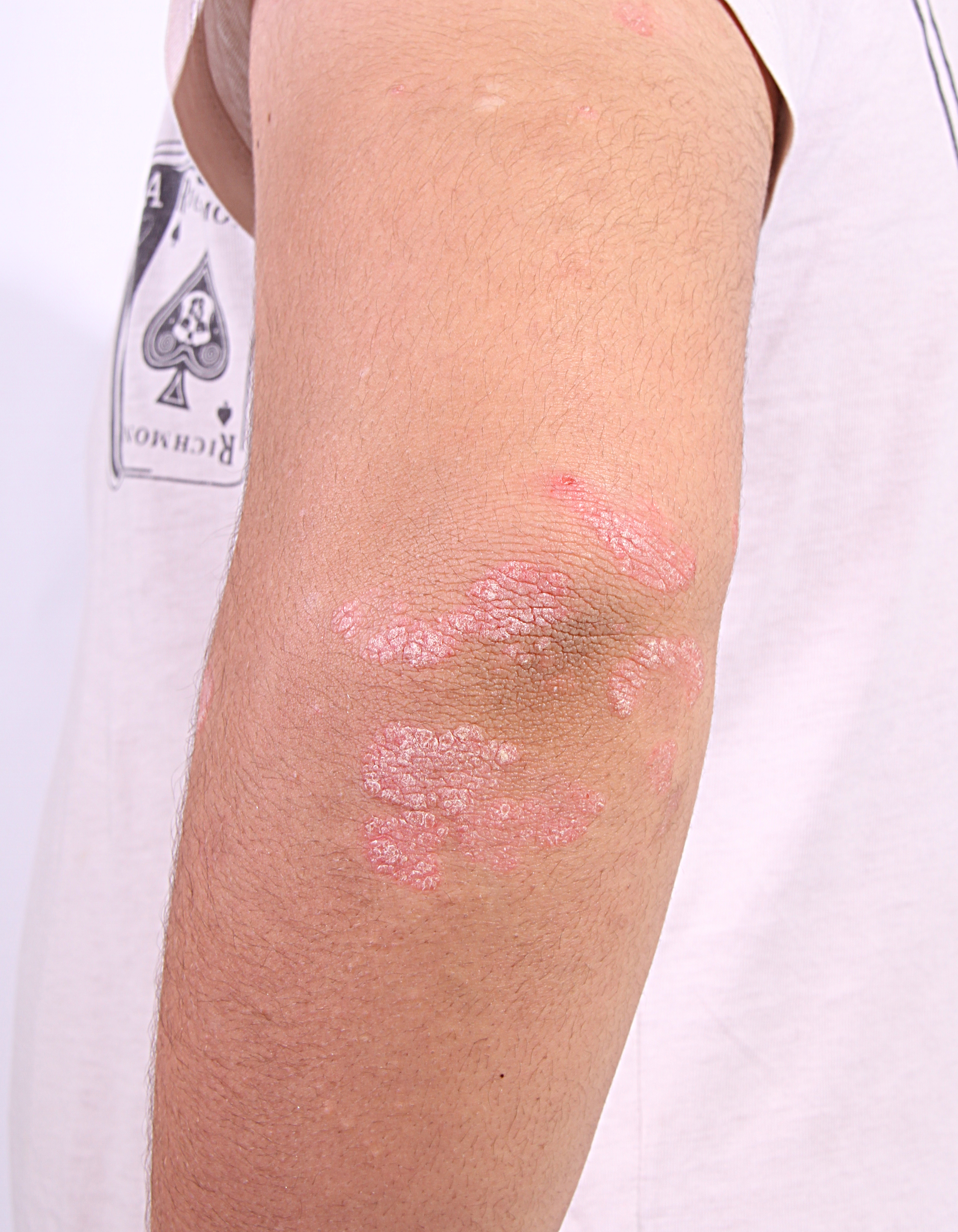 Se desconocen las causas que originan la psoriasis, pero se sabe que es una enfermedad genética que puede detonarse por estrés, cambios hormonales u obesidad, entre otras causas (Foto: Especial)