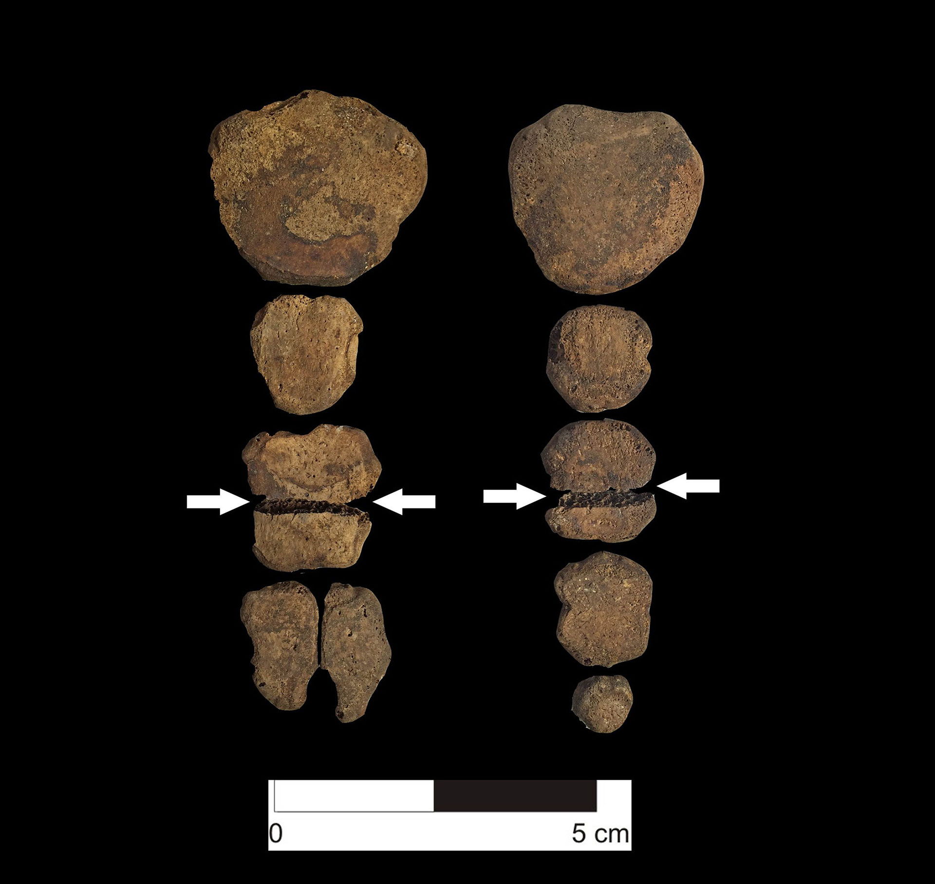 Ejemplos de cortes en el esternón (journals.plos.org)