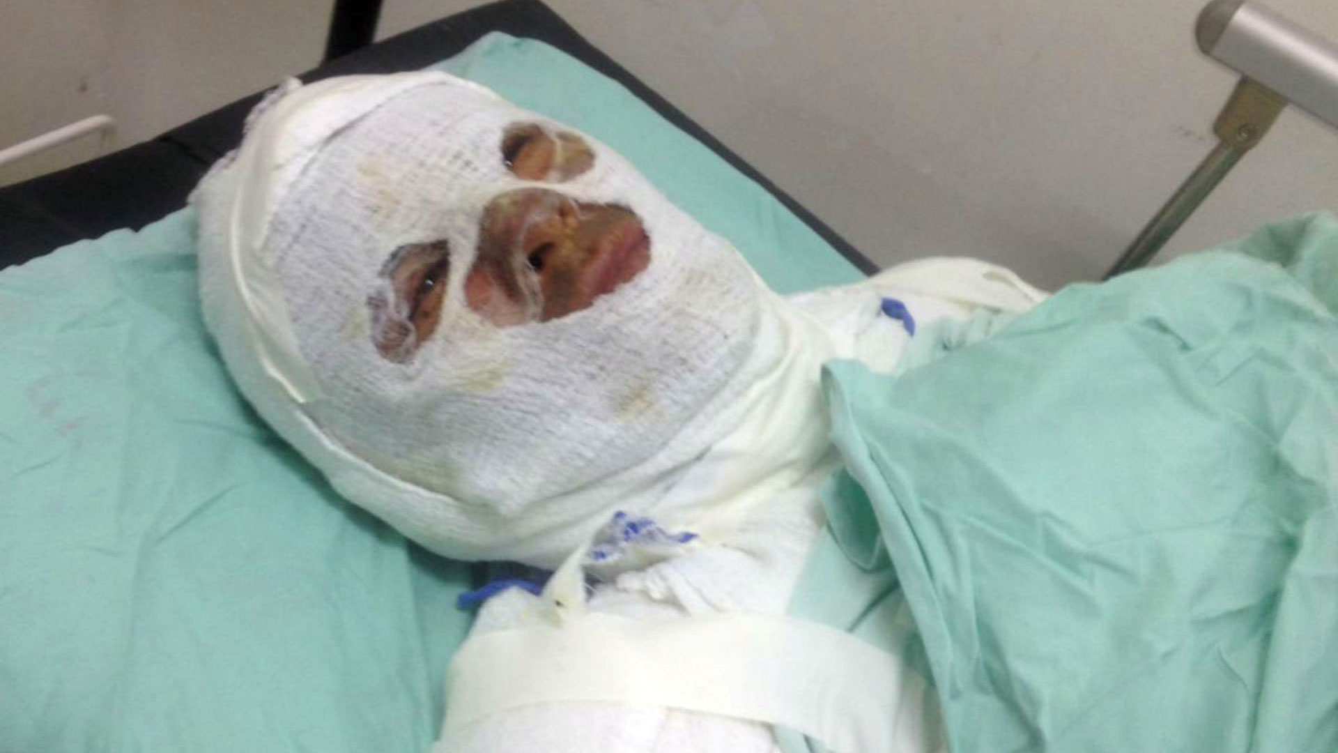 La víctima permanece en el hospital Universitario del Valle, donde atienden sus quemaduras de primer y segundo grado. (Foto RCN Radio)