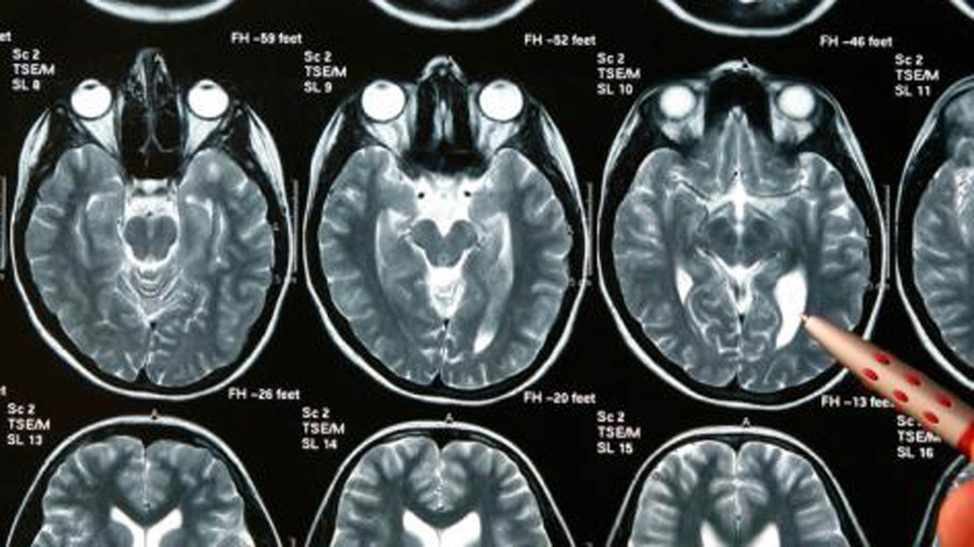Porcentaje de personas con tumores cerebrales
