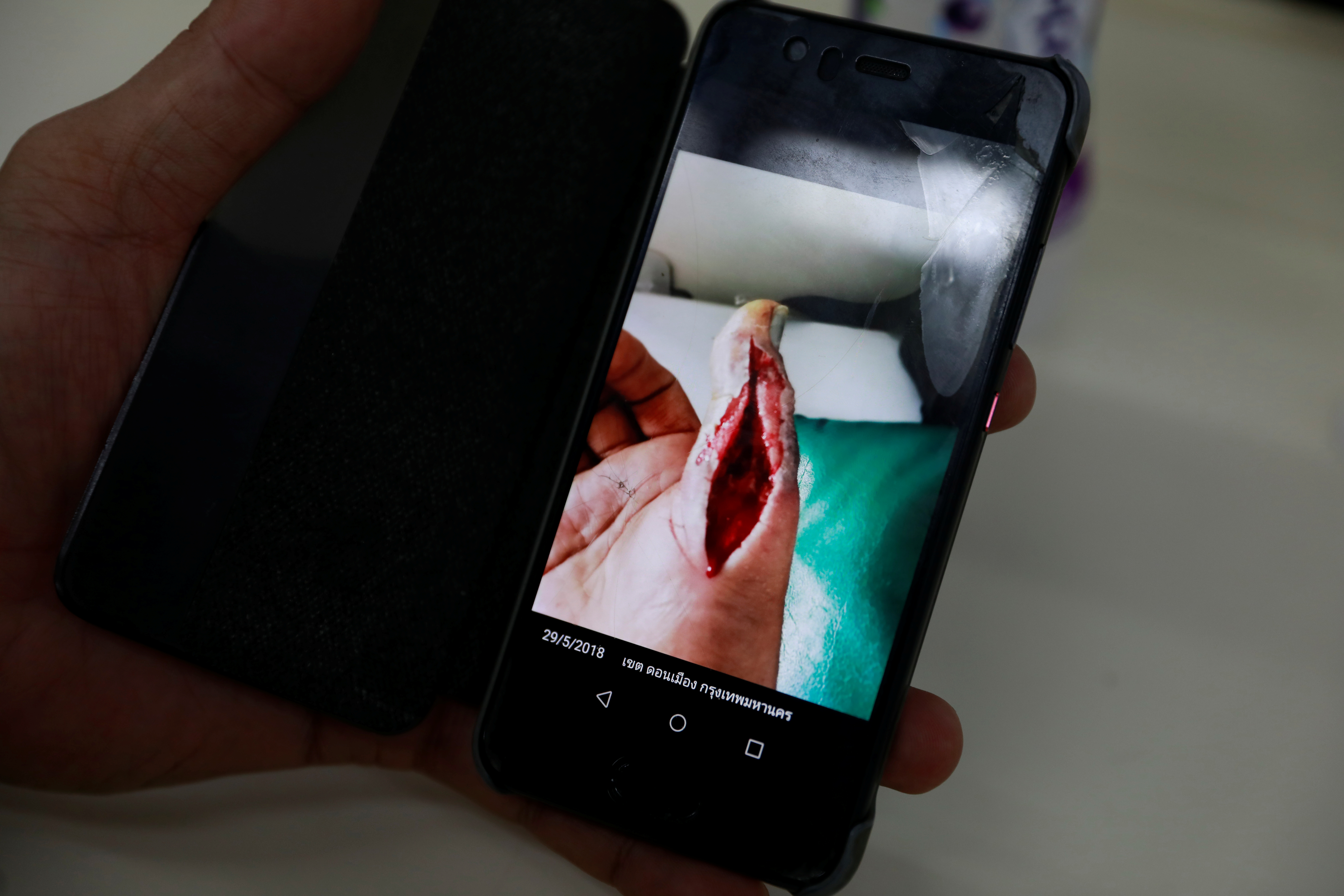 En su celular, muestra la foto de una de las heridas que sufrió por una mordedura en su mano