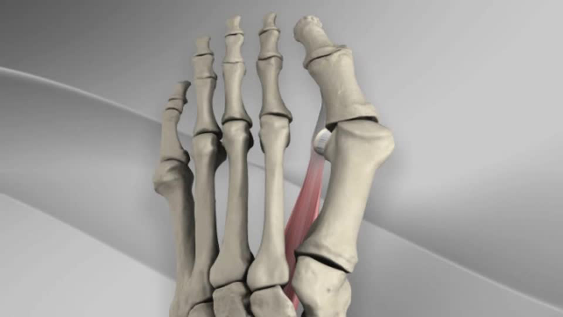 Arthrex First Metatarsal Distal Chevron Osteotomy with LPS Screw