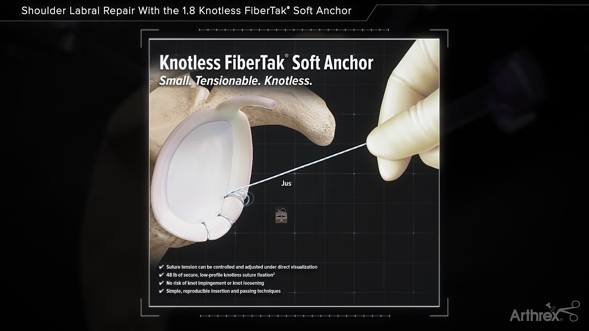 Arthrex Shoulder Labral Repair With the 1.8 Knotless FiberTak® Soft