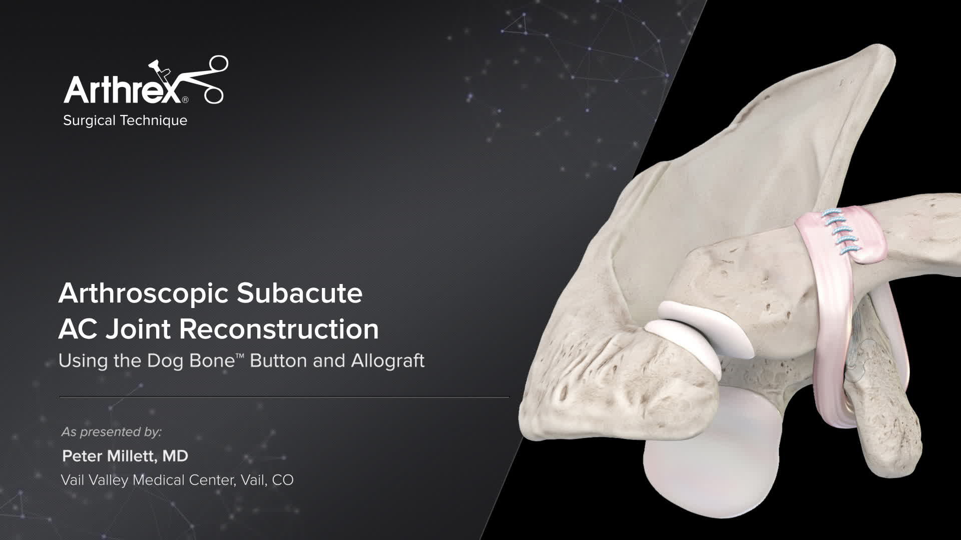 Arthrex Arthroscopic Subacute AC Joint Reconstruction Using the Dog