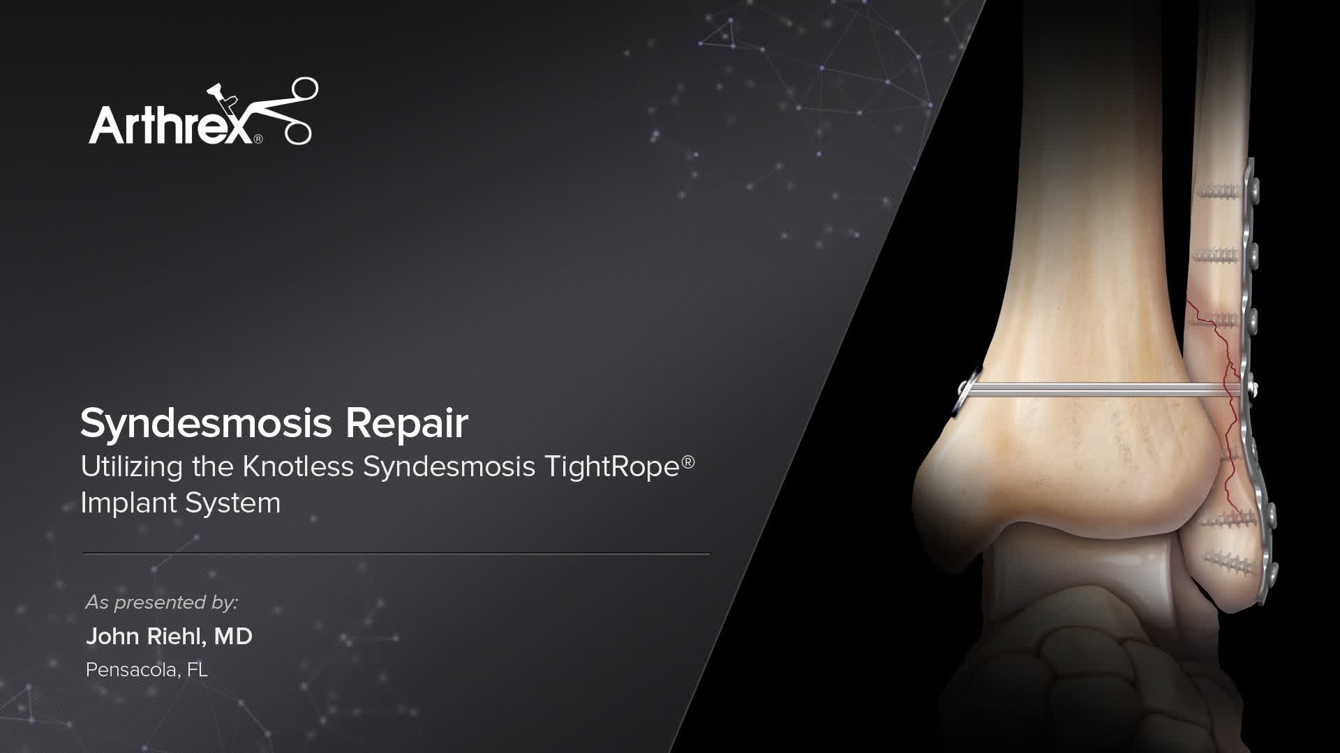 Arthrex - Syndesmosis Repair Utilizing the Knotless Syndesmosis