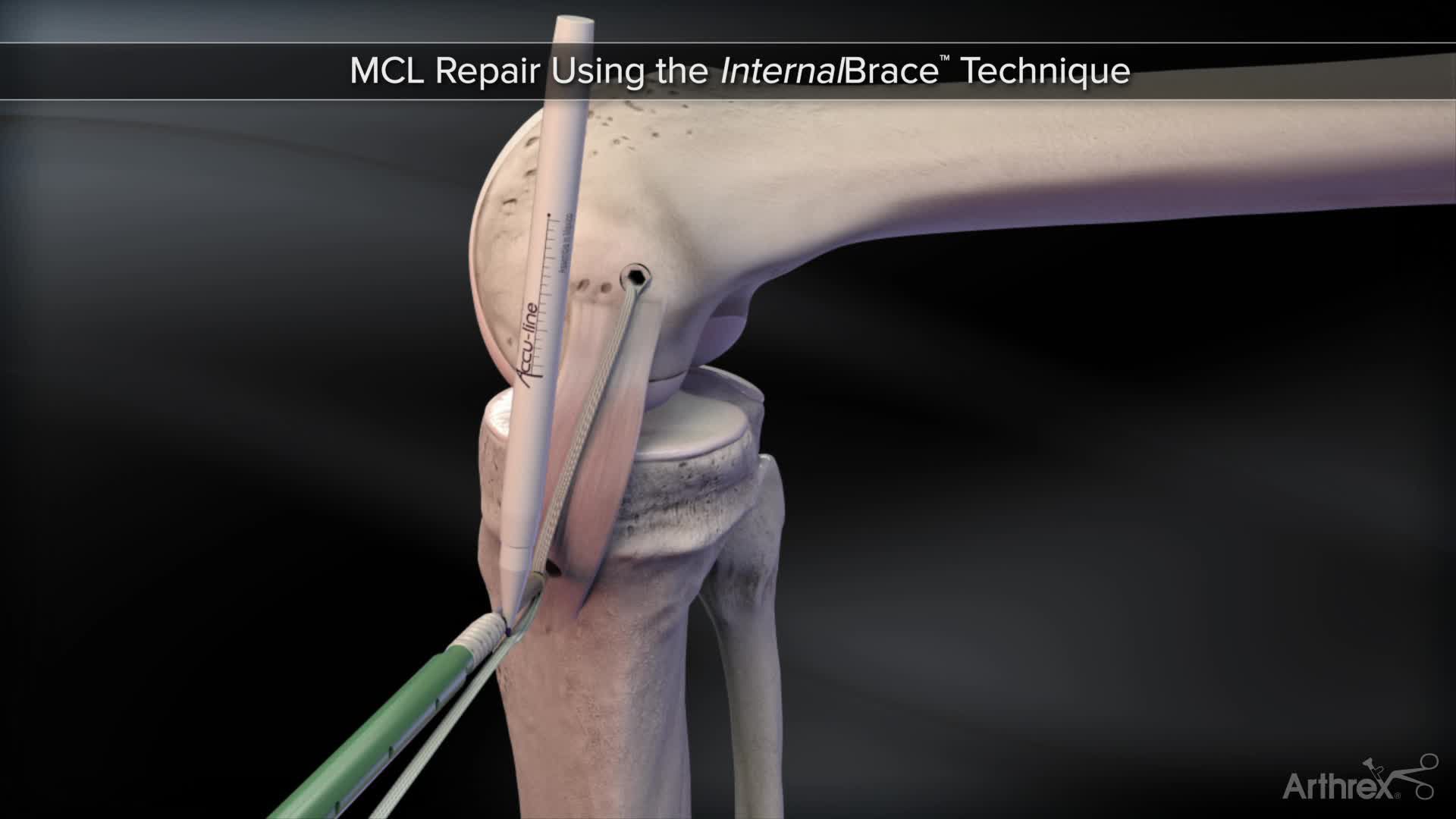 Arthrex InternalBrace™ MCL Augmentation Repair