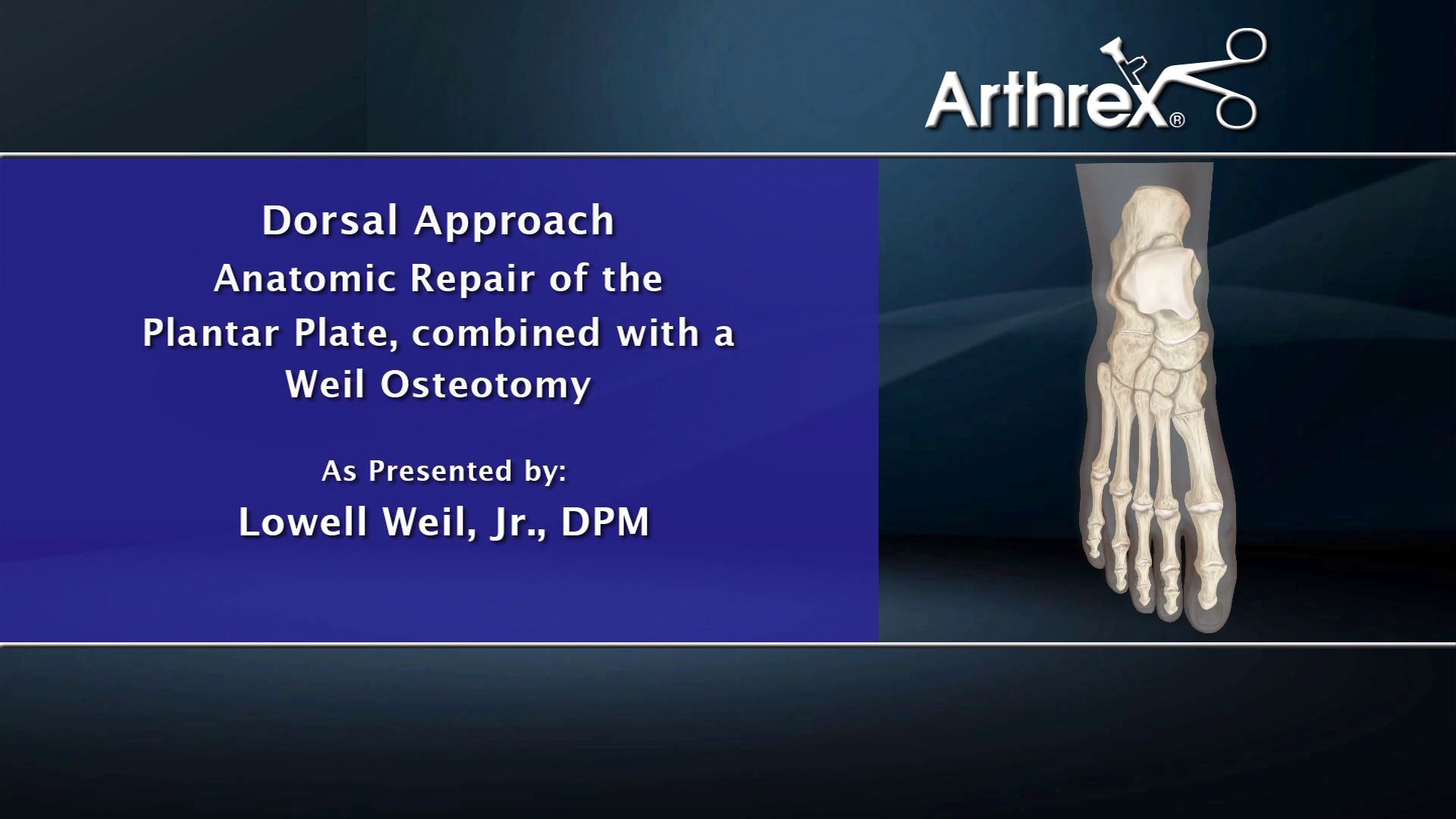 Arthrex Dorsal Approach Anatomic Repair of the Plantar Plate