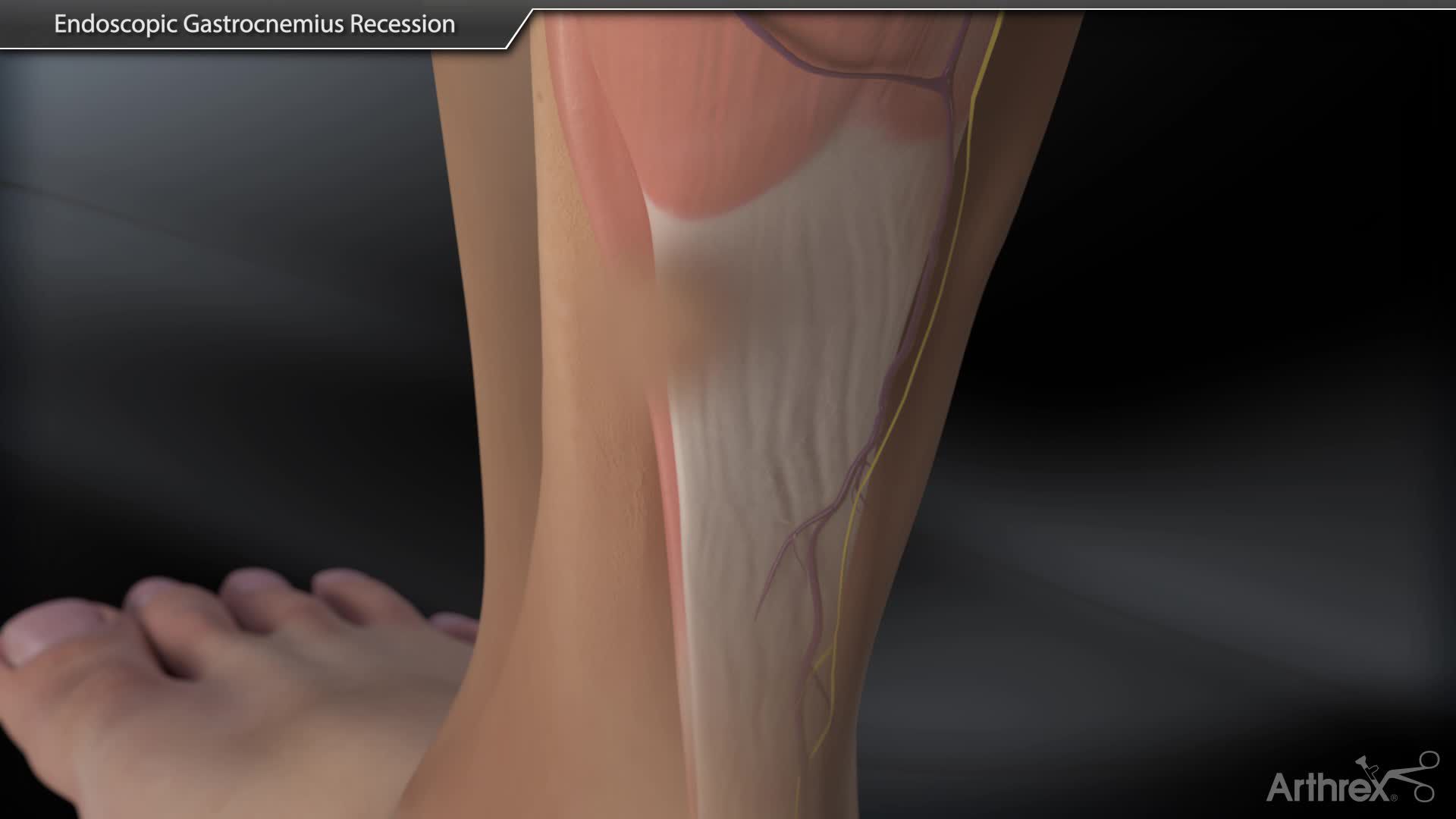 Arthrex Endoscopic Gastrocnemius Recession