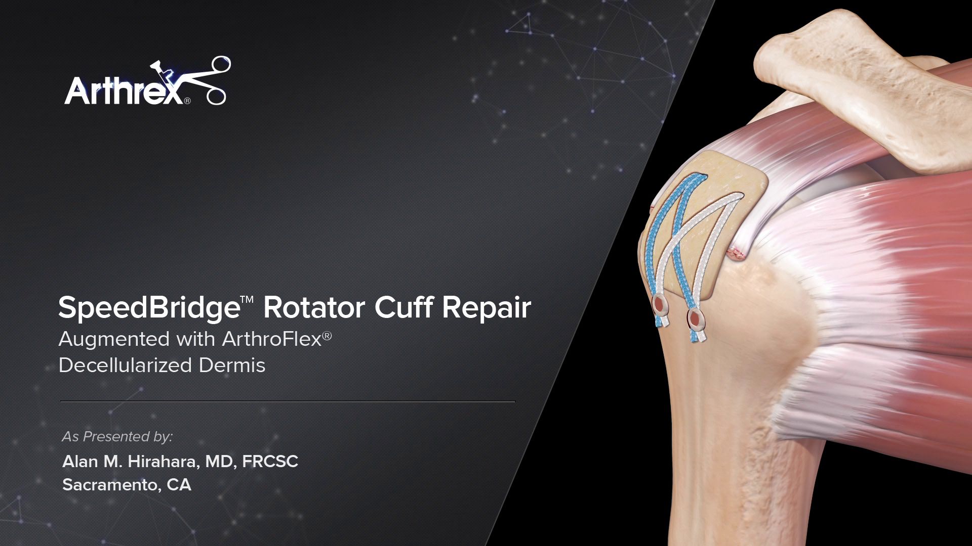 Arthrex SpeedBridge™ Rotator Cuff Repair Augmented with ArthroFlex