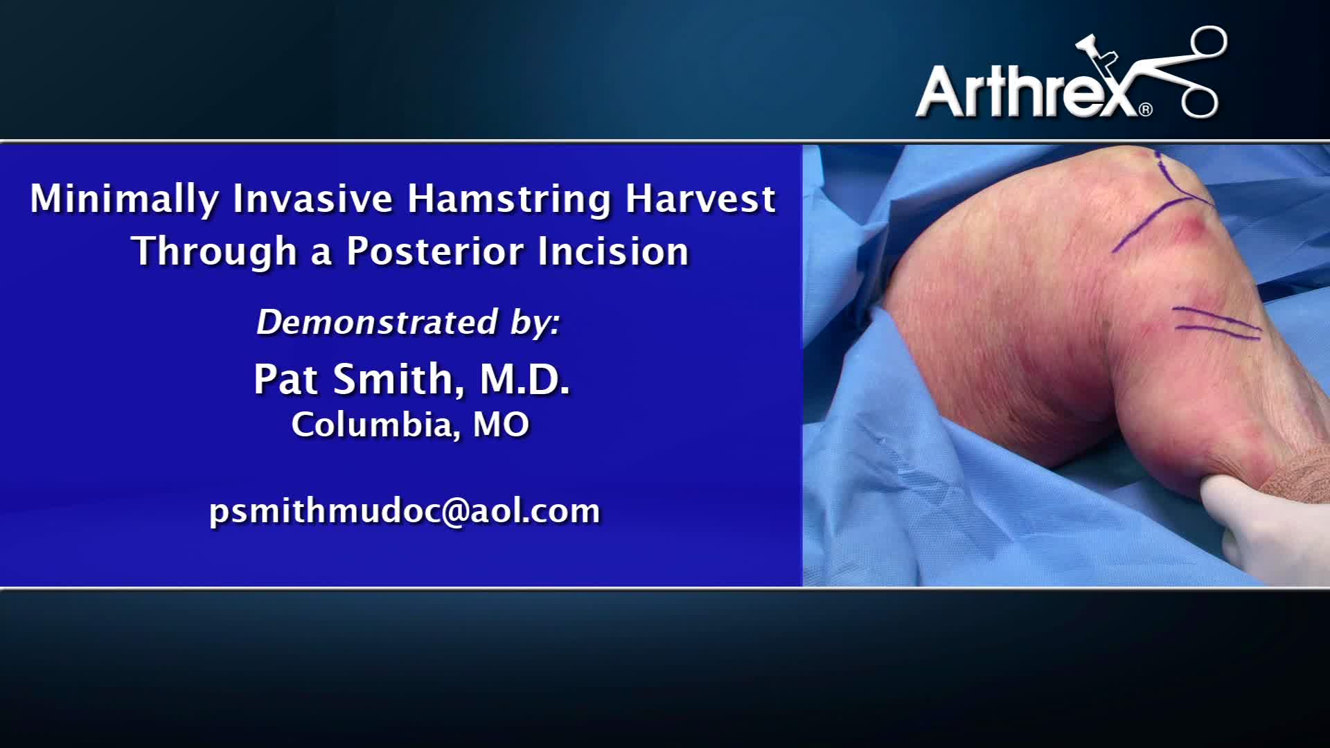 Arthrex Minimally Invasive Hamstring Harvest Through a Posterior Incision