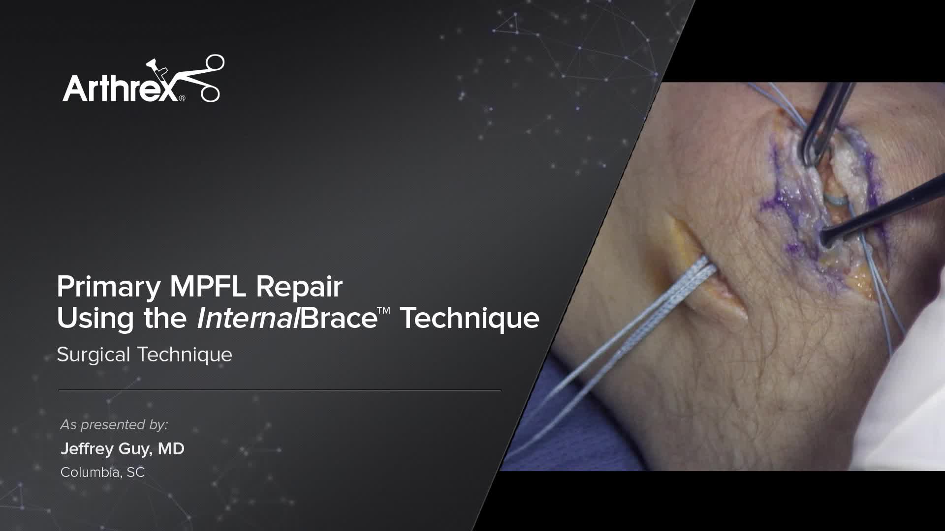 Arthrex Primary MPFL Repair Using the InternalBrace™ Technique