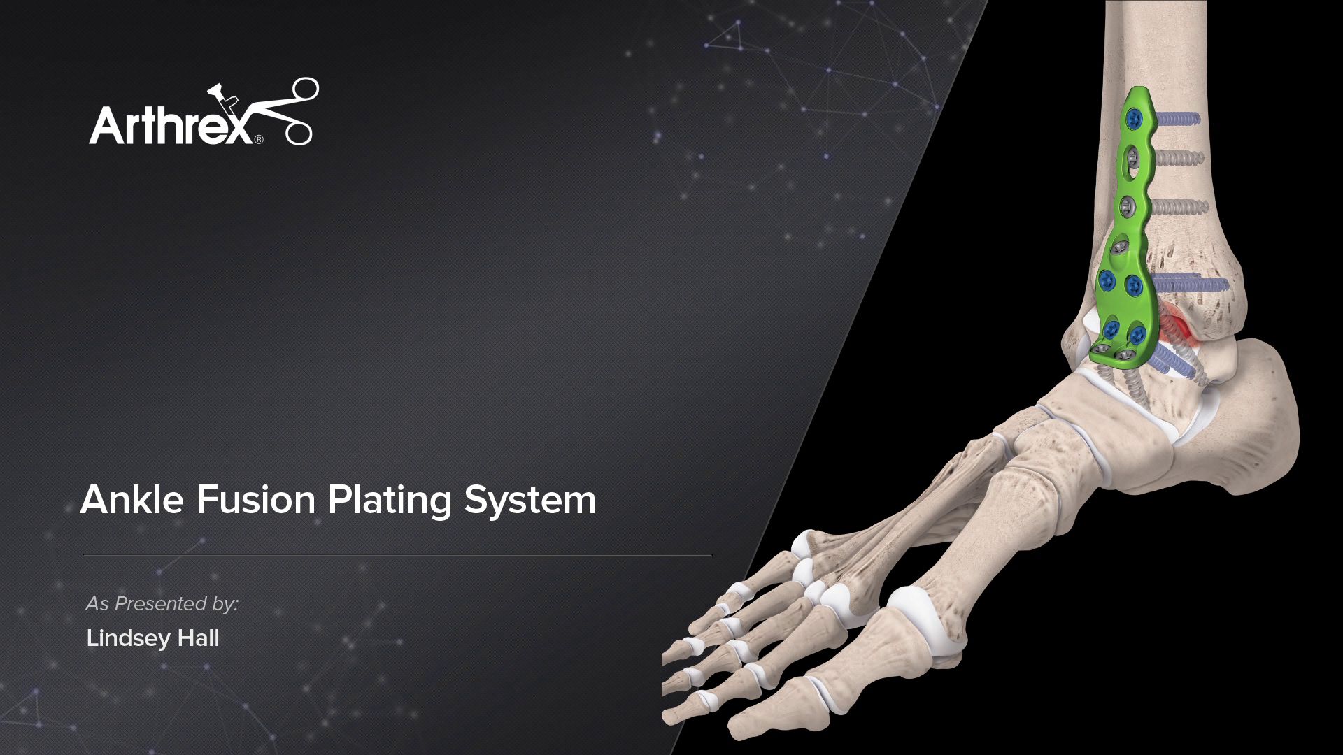 Arthrex Ankle Fusion Plating System