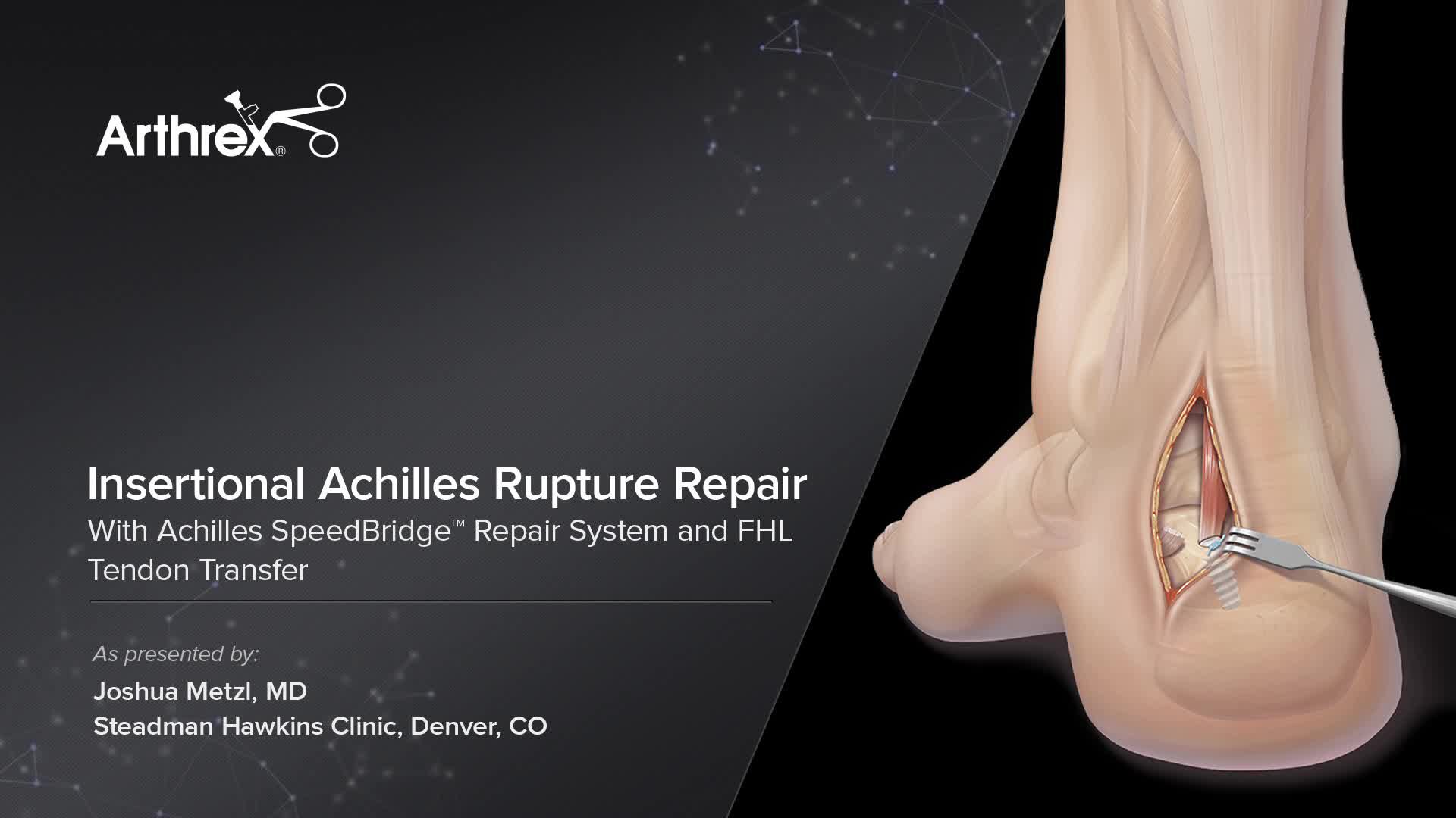 Percutaneous Repair Achilles Tendon – ZXCAIH