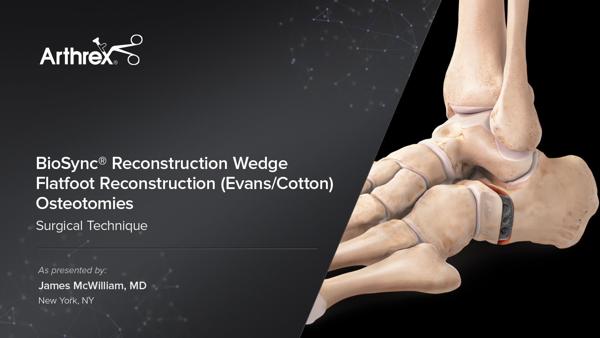 Arthrex BioSync® Reconstruction Wedge Flatfoot Reconstruction (Evans