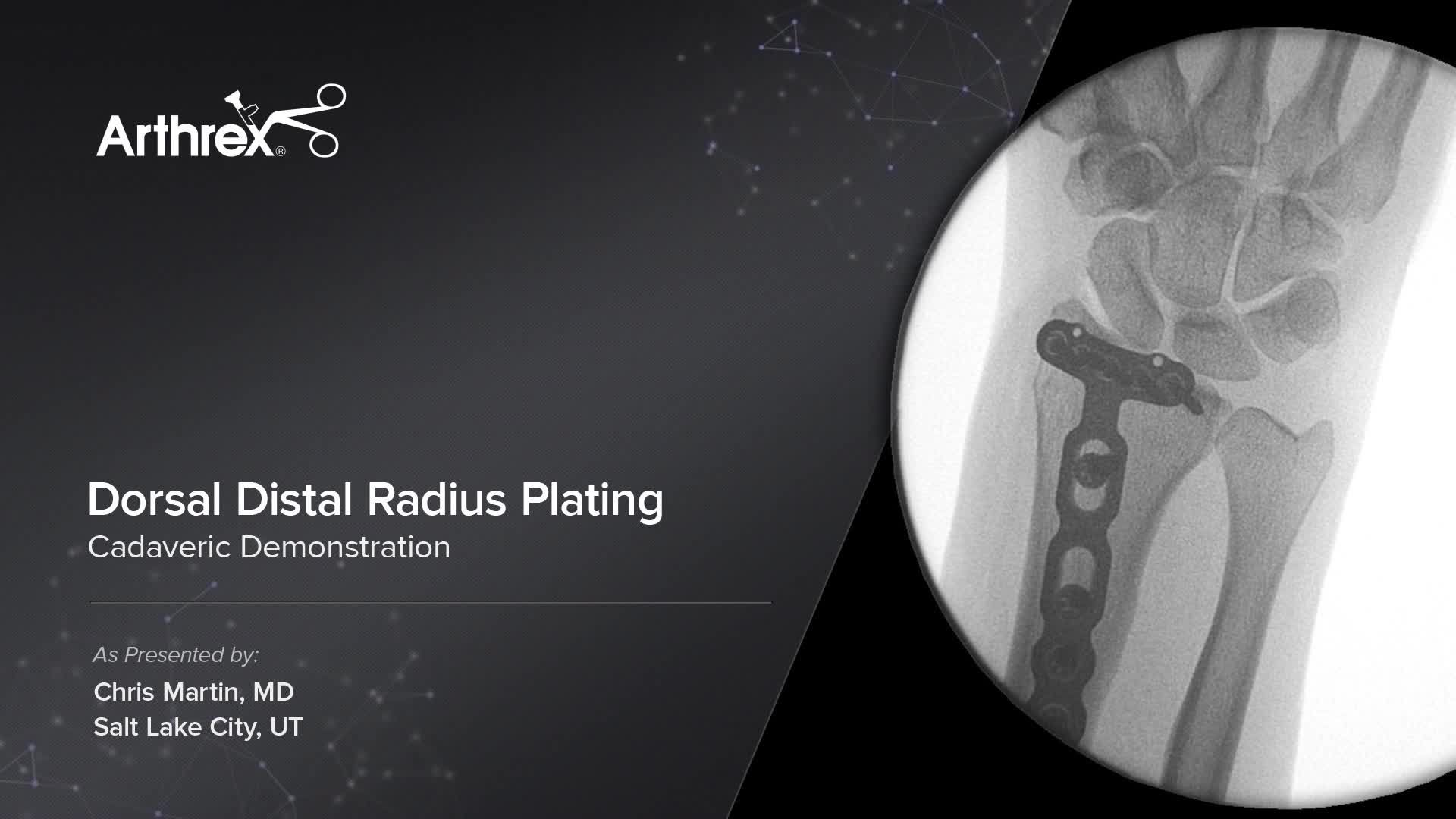 Arthrex Dorsal Distal Radius Plating